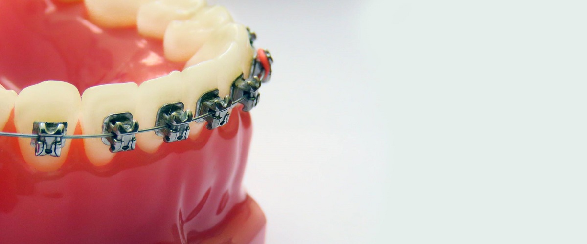 Zahnregulierung, fixe Zahnspange