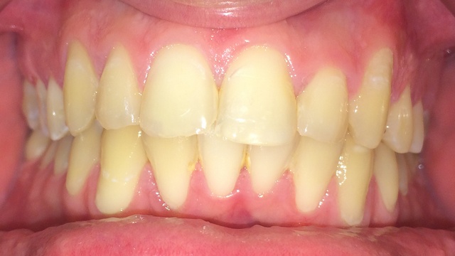 Nach der Zahnregulierung. www.dentall4one.com