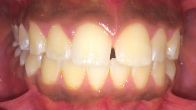 Vor der Zahnregulierung. www.dentall4one.com