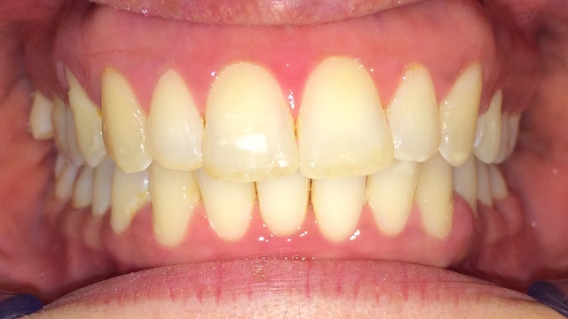Nach der Zahnregulierung. www.dentall4one.com