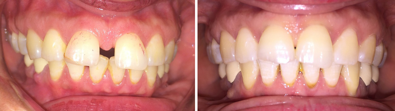 Zahnregulierung Vorher-Nachher. www.dentall4one.com