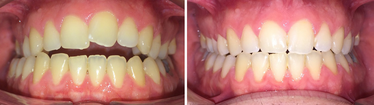 Zahnregulierung Vorher-Nachher. www.dentall4one.com