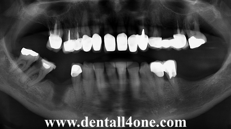 Implantat vorher - www.dentall4one.com