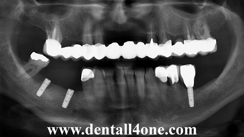 Implantat nachher - www.dentall4one.com
