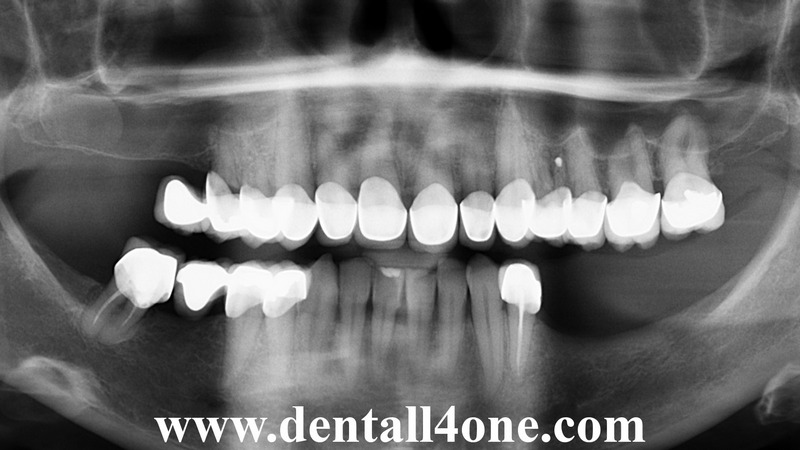 Implantat vorher- www.dentall4one.com