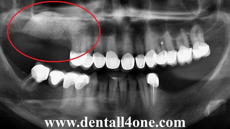 Knochenaufbau nachher - www.dentall4one.com