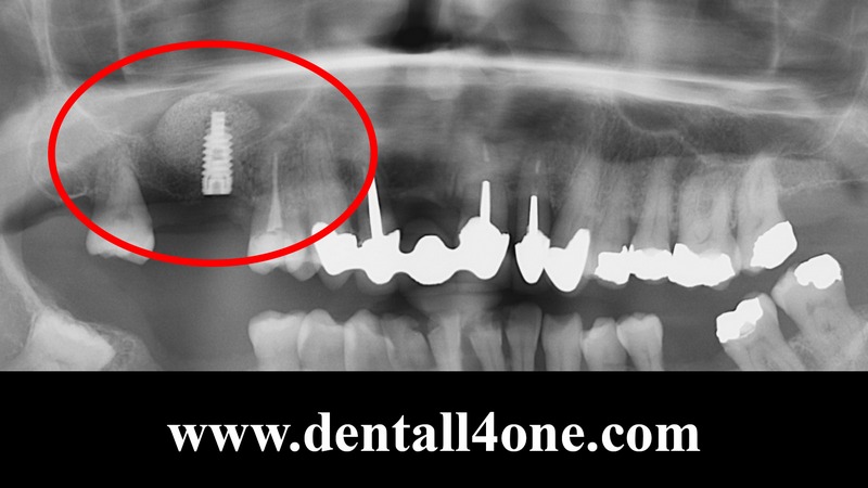 Knochenaufbau nachher - www.dentall4one.com
