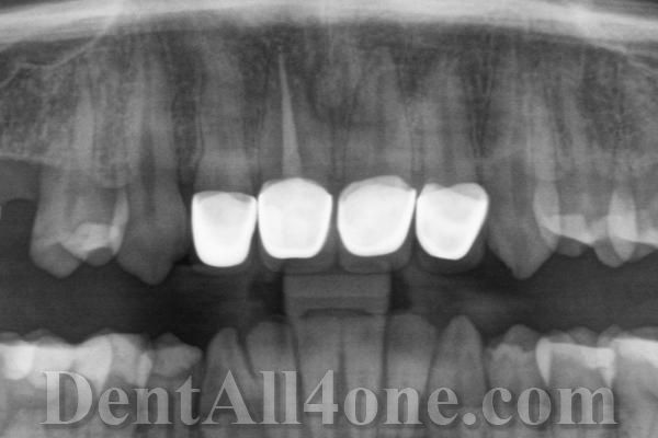 Alte Kronen auf Rtg - DentAll-4-One-Zahnklinik