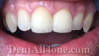 Welche ist Krone - DentAll-4-One-Zahnklinik