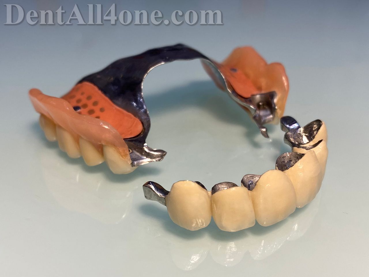 Geschiebeprothese mit Gaumenplatte - www.dentall4one.com