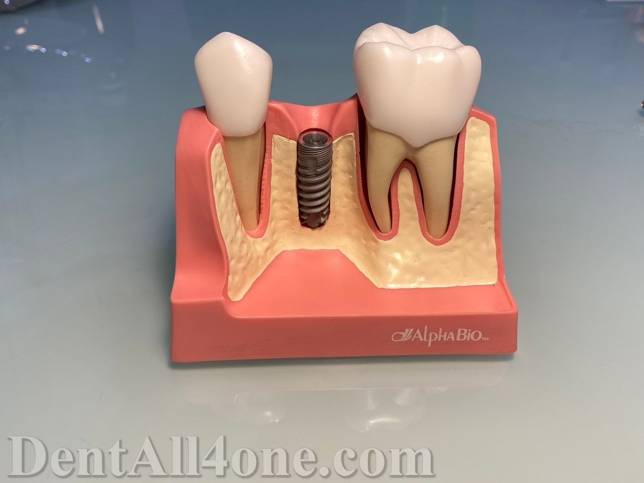 Implantat - www.dentall4one.com
