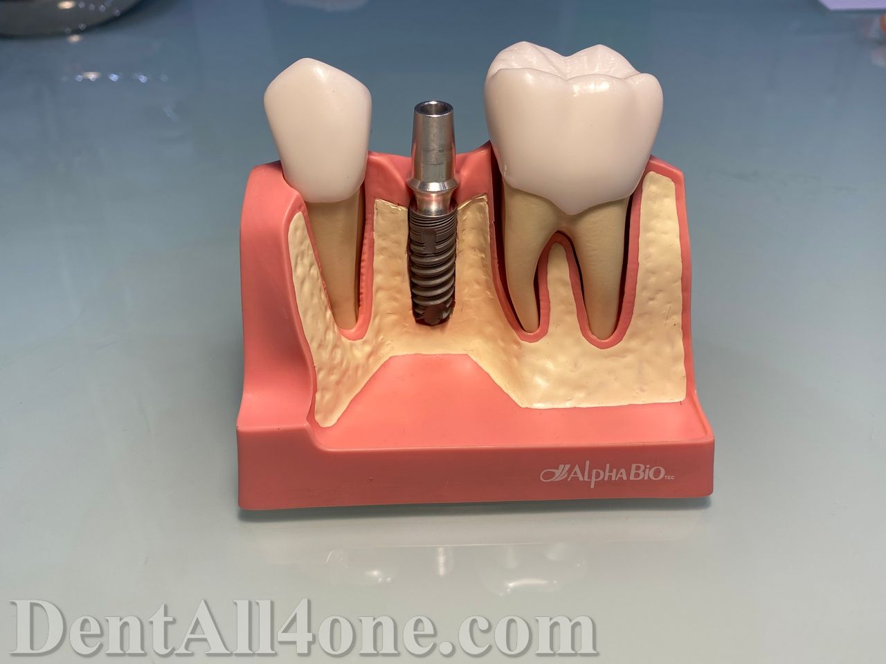 Implantat mit Kopf - www.dentall4one.com