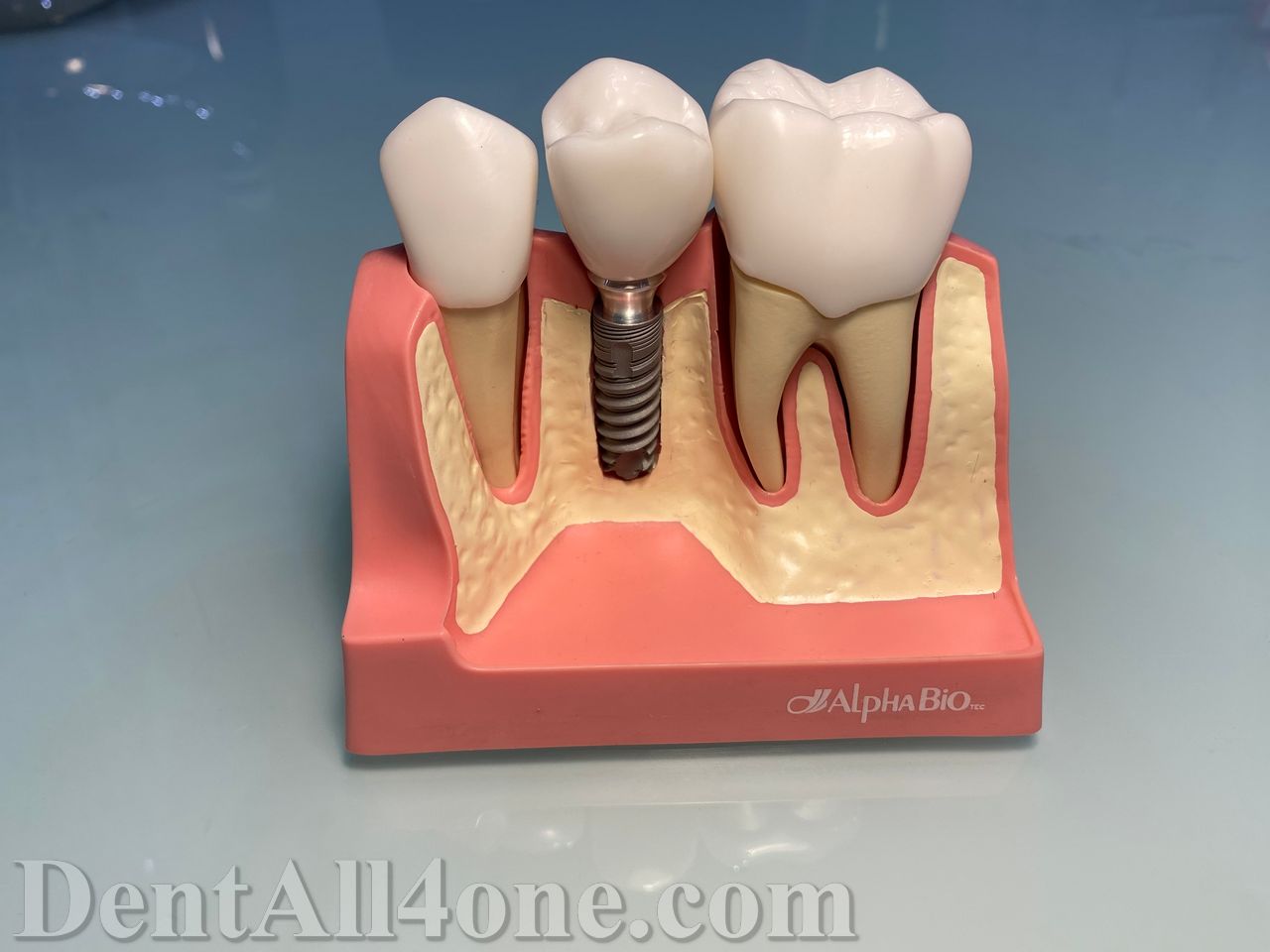 Implantat mit Krone - www.dentall4one.com