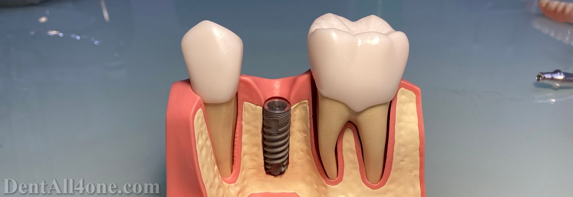 Implantat - www.dentall4one.com