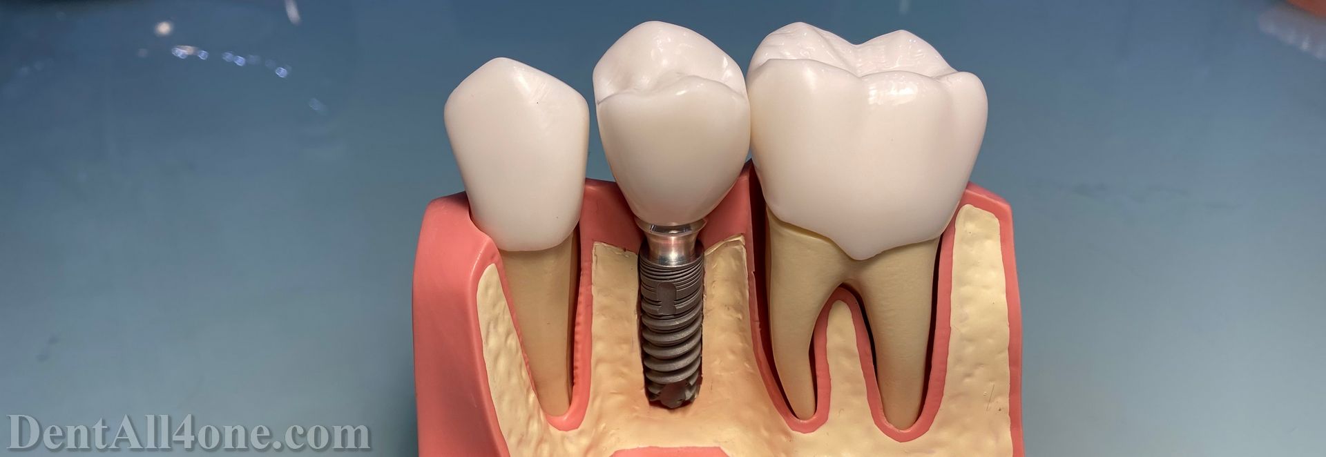 Implantat mit Krone - www.dentall4one.com