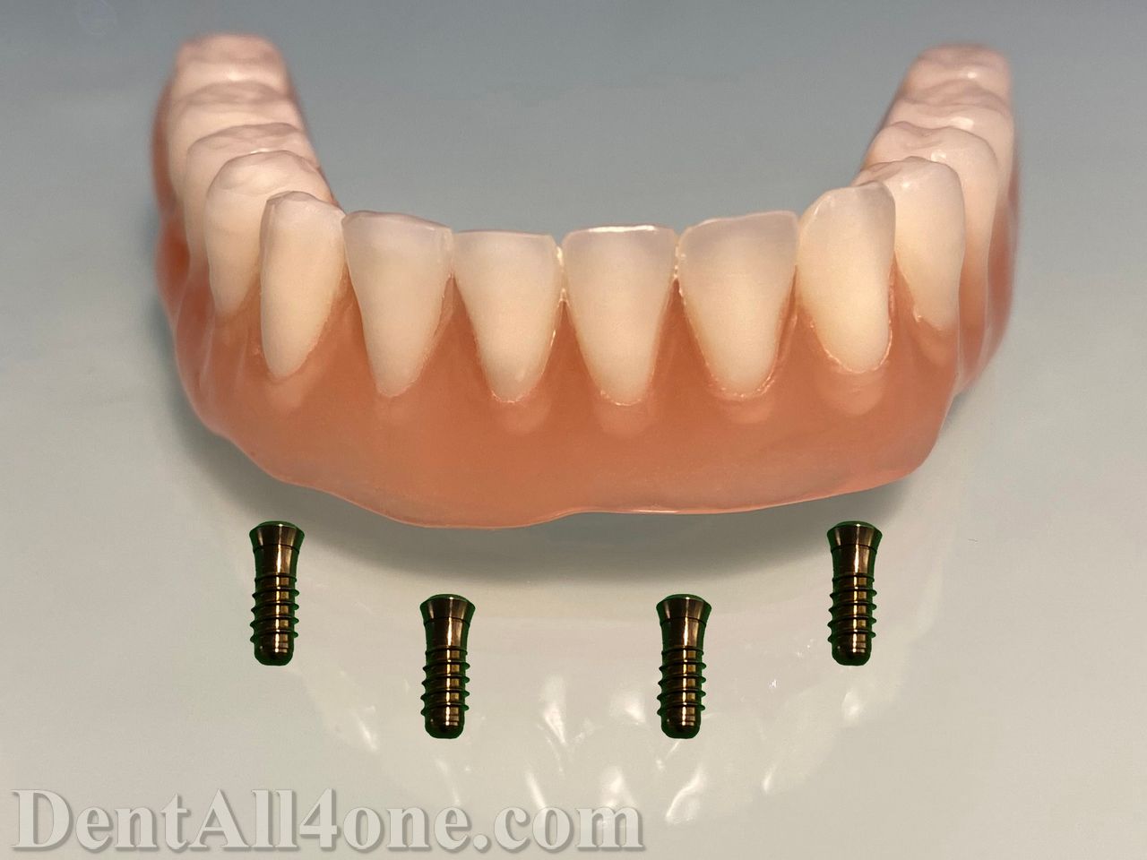 Vollprothese mit Implantat - www.dentall4one.com